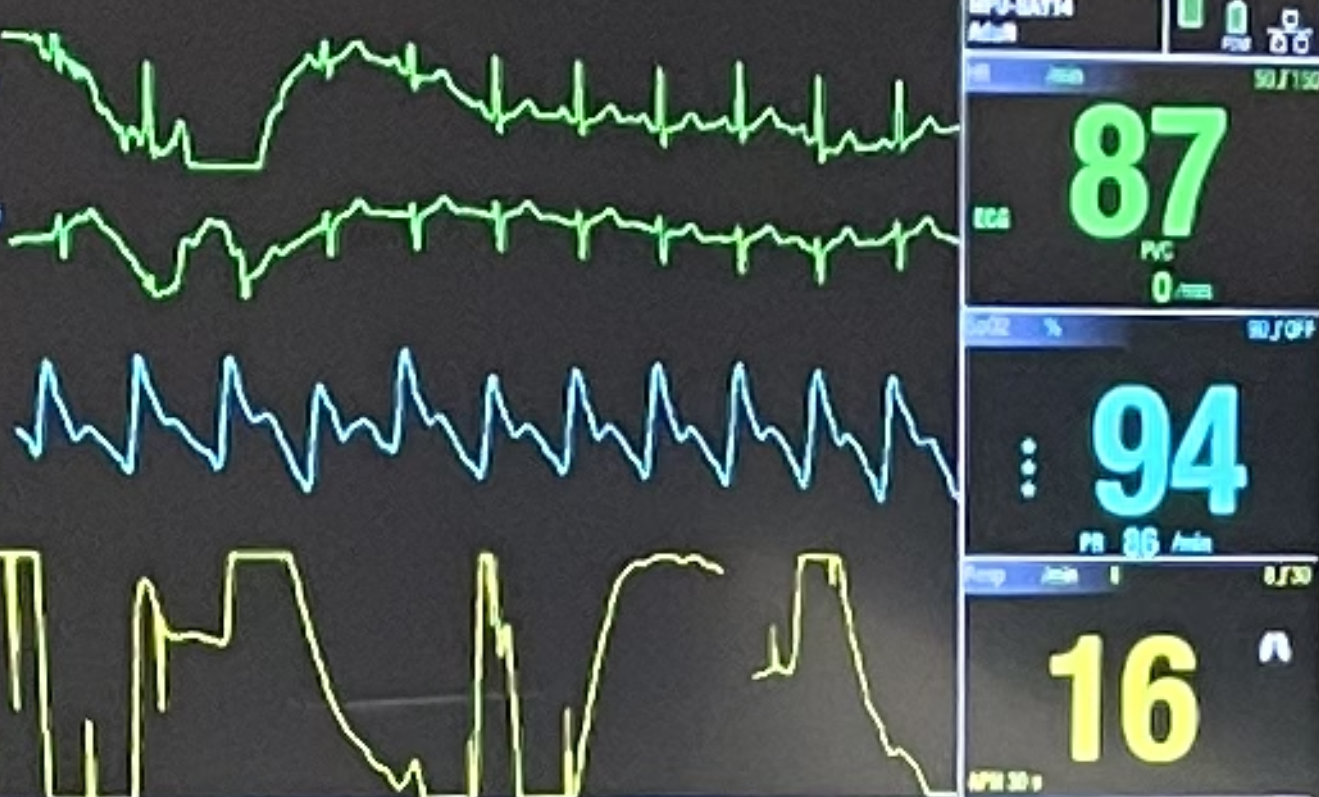 Screenshot of hospital monitor showing EKG, blood oxygenation, and respiration waveforms.